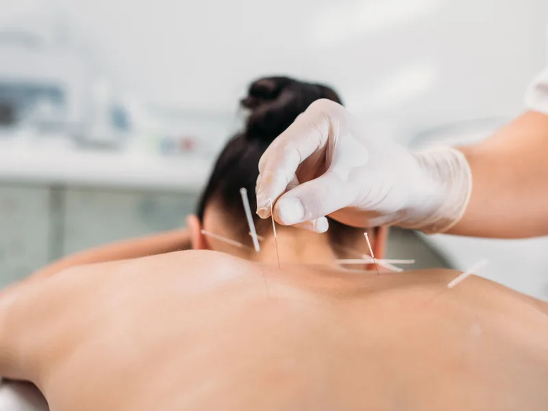 Dry Needling at Bluebonnet Chiropractic in Tomball