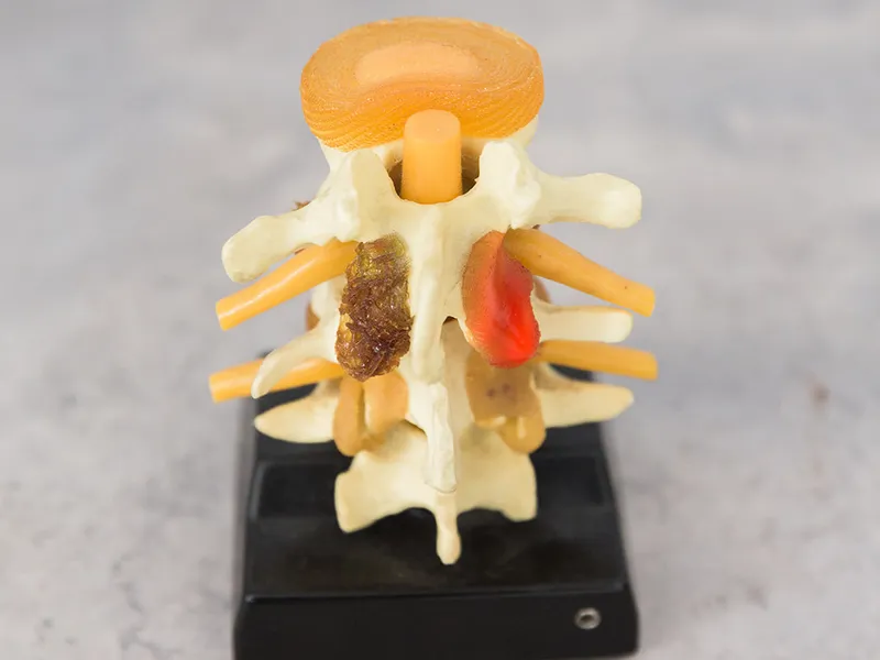 Bluebonnet Chiropractic treating pinched nerve in Tomball